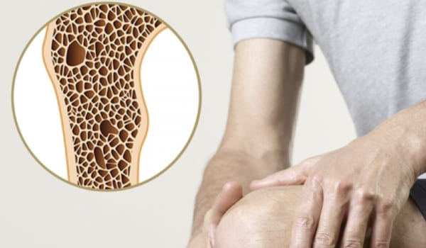 Manejo de osteoporosis